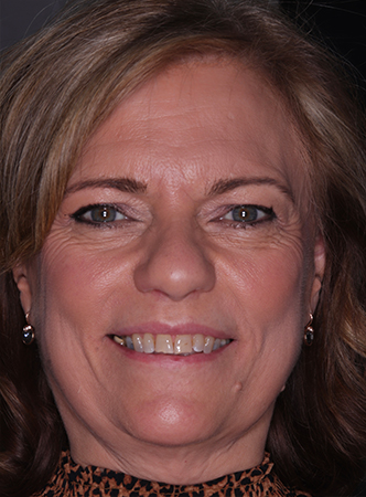 Before - Meliora Dental