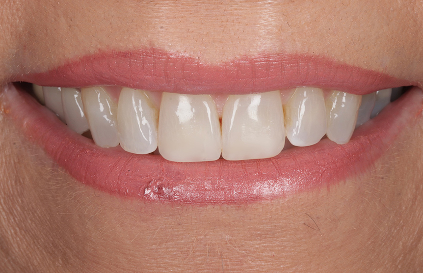 After - Meliora Dental