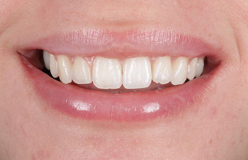 After - Meliora Dental